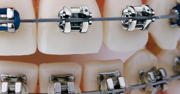 Brackets SmartClip™ - Almacen Dental Corp