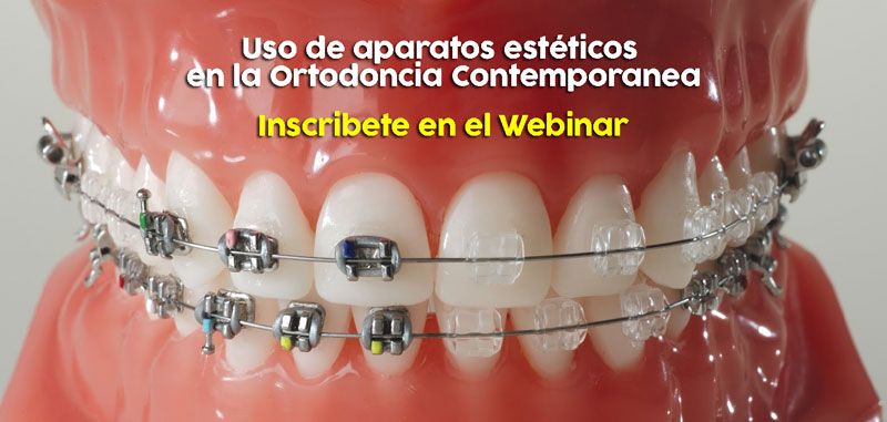 Uso De Aparatos Esteticos En La Ortodoncia Contemporanea Almacen Dental Corp